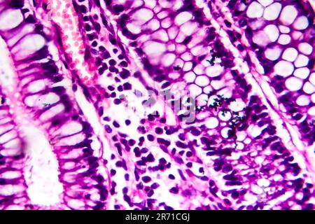 Dysenterie bacillaire, micrographe léger, photo sous microscope montrant la présence de bactéries et l'accumulation de cellules inflammatoires Banque D'Images