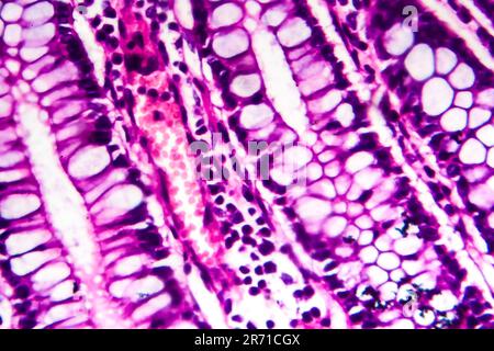 Dysenterie bacillaire, micrographe léger, photo sous microscope montrant la présence de bactéries et l'accumulation de cellules inflammatoires Banque D'Images