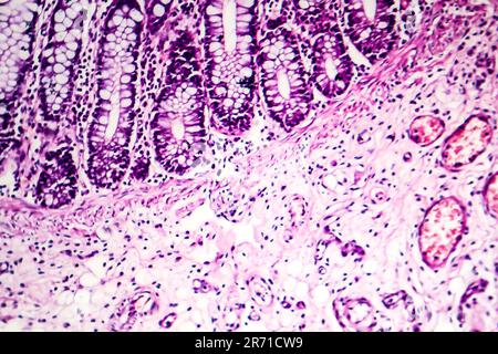 Dysenterie bacillaire, micrographe léger, photo sous microscope montrant l'accumulation de cellules inflammatoires dans les tissus de l'épithélium et du subépithelium Banque D'Images