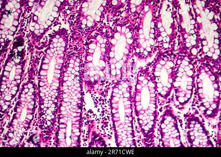 Dysenterie bacillaire, micrographe léger, photo sous microscope montrant la présence de bactéries et l'accumulation de cellules inflammatoires Banque D'Images