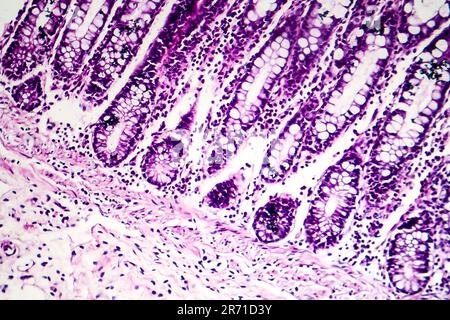 Dysenterie bacillaire, micrographe léger, photo sous microscope montrant l'accumulation de cellules inflammatoires dans les tissus de l'épithélium et du subépithelium Banque D'Images