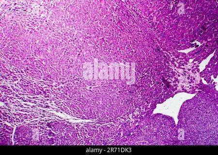 Carcinome hépatocellulaire, cancer du foie, micrographe léger, photo au microscope Banque D'Images