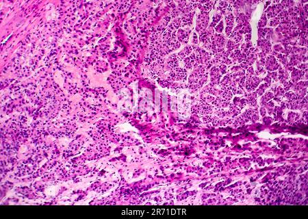 Carcinome hépatocellulaire, cancer du foie, micrographe léger, photo au microscope Banque D'Images