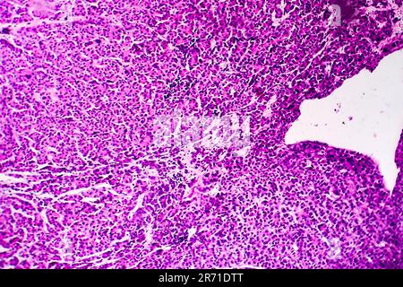 Carcinome hépatocellulaire, cancer du foie, micrographe léger, photo au microscope Banque D'Images