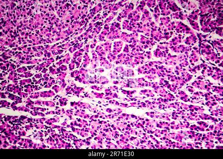 Carcinome hépatocellulaire, cancer du foie, micrographe léger, photo au microscope Banque D'Images