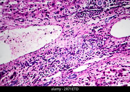 Carcinome hépatocellulaire, cancer du foie, micrographe léger, photo au microscope Banque D'Images