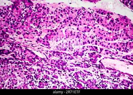 Carcinome hépatocellulaire, cancer du foie, micrographe léger, photo au microscope Banque D'Images