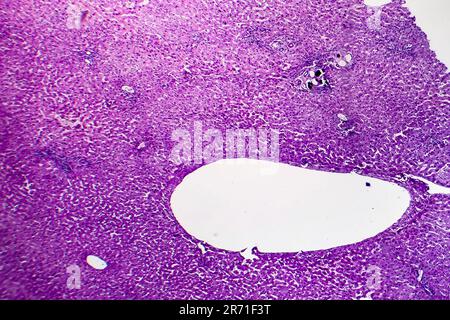 Schistosomiase hépatique, micrographe léger, photo sous microscope montrant la présence de Schistosoma ova, oeufs calcifiés du ver plat, dans le tissu hépatique Banque D'Images