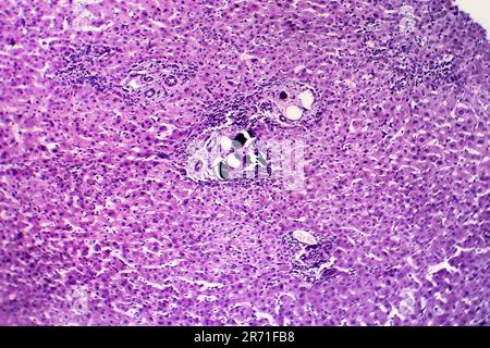 Schistosomiase hépatique, micrographe léger, photo sous microscope montrant la présence de Schistosoma ova, oeufs calcifiés du ver plat, dans le tissu hépatique Banque D'Images