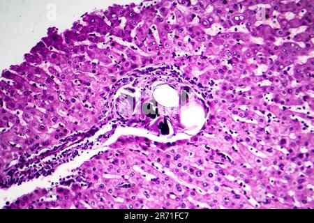 Schistosomiase hépatique, micrographe léger, photo sous microscope montrant la présence de Schistosoma ova, oeufs calcifiés du ver plat, dans le tissu hépatique Banque D'Images