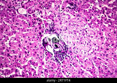 Schistosomiase hépatique, micrographe léger, photo sous microscope montrant la présence de Schistosoma ova, oeufs calcifiés du ver plat, dans le tissu hépatique Banque D'Images