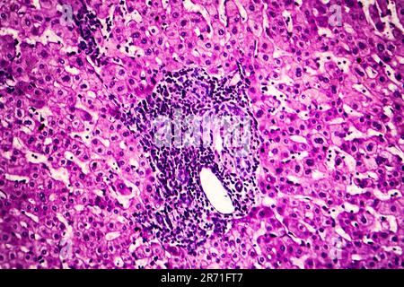 Schistosomiase hépatique, micrographe léger, photo sous microscope montrant la présence de Schistosoma ova, oeufs calcifiés du ver plat, dans le tissu hépatique Banque D'Images