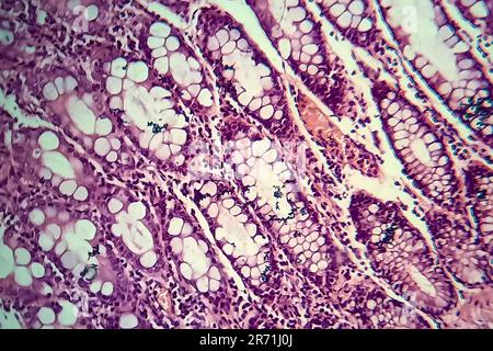 Dysenterie bacillaire, micrographe léger, photo sous microscope montrant la présence de bactéries et l'accumulation de cellules inflammatoires dans l'épithète intestinal Banque D'Images