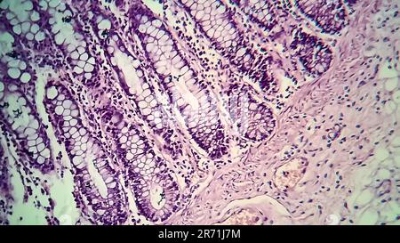 Dysenterie Bacillaire Micrographe L Ger Photo Sous Microscope Montrant La Pr Sence De