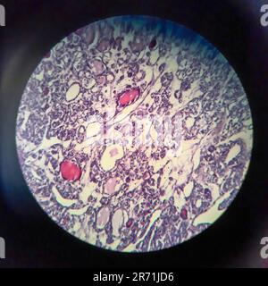 Carcinome folliculaire thyroïdien, micrographe léger, photo sous microscope Banque D'Images