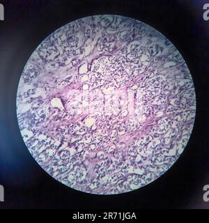 Carcinome folliculaire thyroïdien, micrographe léger, photo sous microscope Banque D'Images