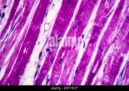 Histopathologie de l'hypertrophie cardiaque, fort grossissement. Photomicrographe montrant le myocarde hypertrophique avec des fibres musculaires épaisses et élargi et dar Banque D'Images