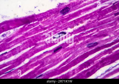 Histopathologie de l'hypertrophie cardiaque, fort grossissement. Photomicrographe montrant le myocarde hypertrophique avec des fibres musculaires épaisses et élargi et dar Banque D'Images