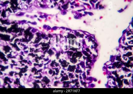 Histopathologie du poumon du fumeur. Micrographe lumineux montrant l'accumulation de particules de carbone dans le tissu pulmonaire Banque D'Images