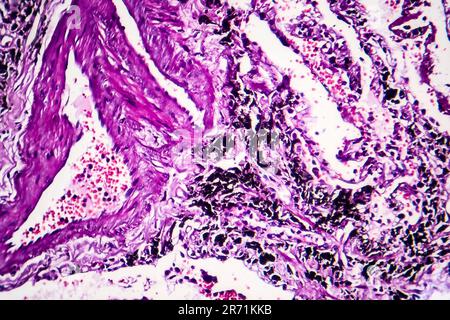 Histopathologie du poumon du fumeur. Micrographe lumineux montrant l'accumulation de particules de carbone dans le tissu pulmonaire Banque D'Images