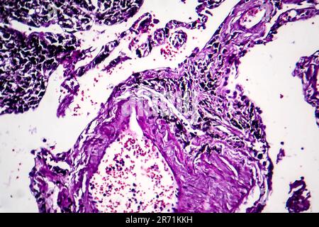 Histopathologie du poumon du fumeur. Micrographe lumineux montrant l'accumulation de particules de carbone dans le tissu pulmonaire Banque D'Images