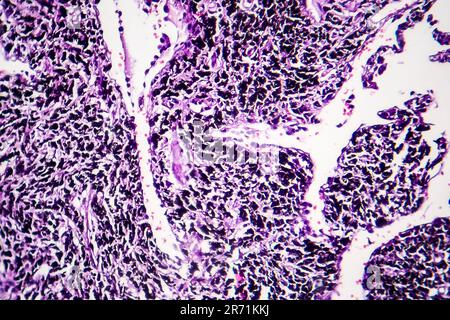 Histopathologie du poumon du fumeur. Micrographe lumineux montrant l'accumulation de particules de carbone dans le tissu pulmonaire Banque D'Images