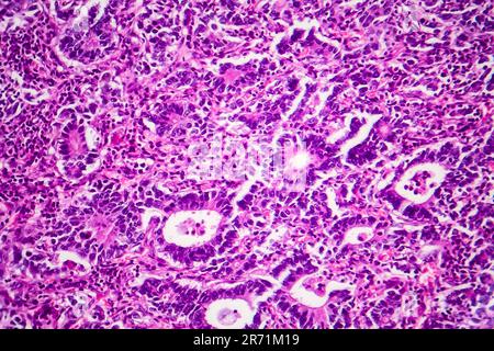 Adénocarcinome gastrique, micrographe léger, photo sous microscope Banque D'Images