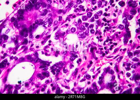 Adénocarcinome gastrique, micrographe léger, photo sous microscope. Agrandissement élevé Banque D'Images