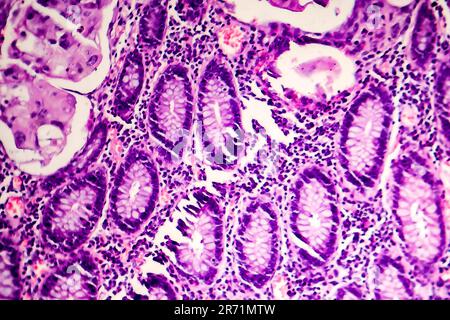 L'adénocarcinome peu différencié de la lumière intestinale, micrographie, photo sous microscope Banque D'Images