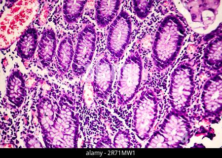 L'adénocarcinome peu différencié de la lumière intestinale, micrographie, photo sous microscope Banque D'Images