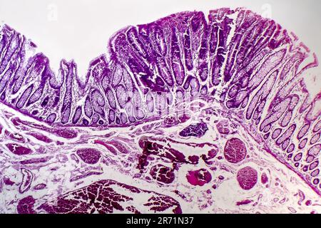 Adénocarcinome du côlon villeux, micrographe léger, photo sous microscope Banque D'Images