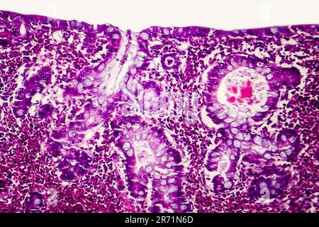 Adénocarcinome du côlon villeux, micrographe léger, photo sous microscope Banque D'Images