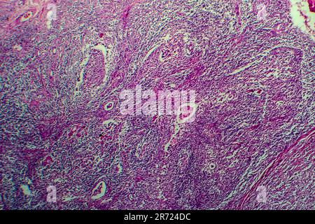 Lymphome de Hodgkin, micrographe léger, photo sous microscope Banque D'Images