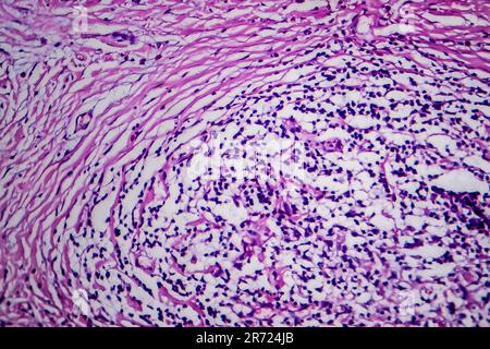 Lymphome de Hodgkin, micrographe léger, photo sous microscope Banque D'Images