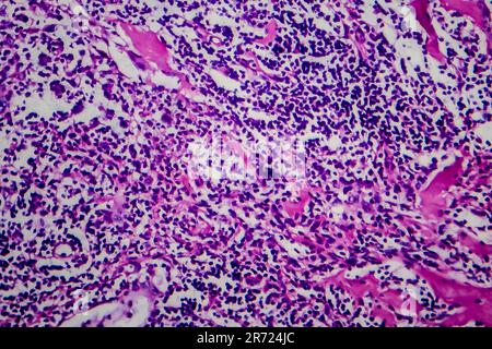 Lymphome de Hodgkin, micrographe léger, photo sous microscope Banque D'Images