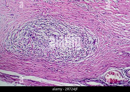 Lymphome de Hodgkin, micrographe léger, photo sous microscope Banque D'Images