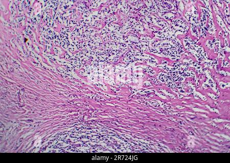 Lymphome de Hodgkin, micrographe léger, photo sous microscope Banque D'Images