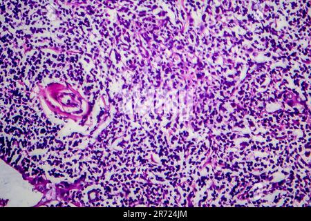 Lymphome de Hodgkin, micrographe léger, photo sous microscope Banque D'Images