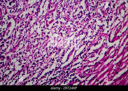 Lymphome de Hodgkin, micrographe léger, photo sous microscope Banque D'Images