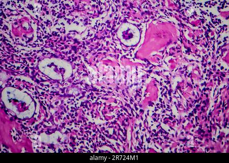 Lymphome de Hodgkin, micrographe léger, photo sous microscope Banque D'Images