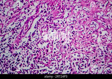 Lymphome de Hodgkin, micrographe léger, photo sous microscope Banque D'Images