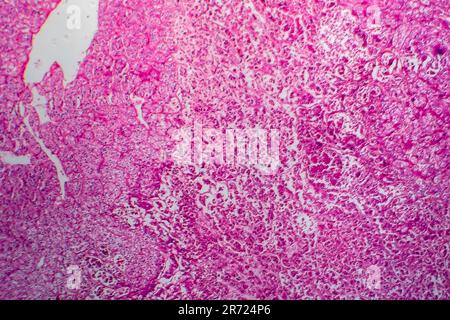 Carcinome des cellules rénales, micrographe léger, photo sous microscope Banque D'Images