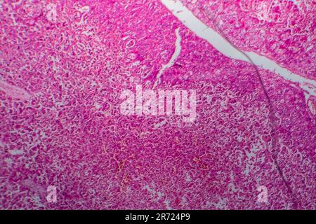 Carcinome des cellules rénales, micrographe léger, photo sous microscope Banque D'Images