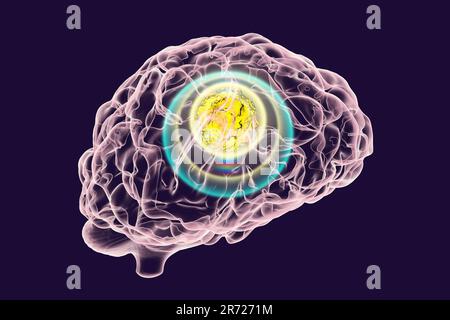 Image conceptuelle pour le traitement du cancer du cerveau. Illustration d'un ordinateur montrant la destruction d'une tumeur cérébrale. Banque D'Images