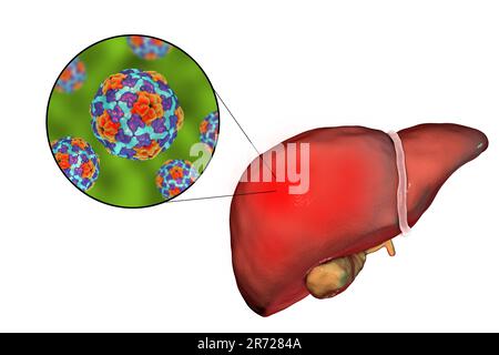 Foie avec hépatite et vue rapprochée des virus de l'hépatite A, illustration. L'hépatite A est transmise par des aliments ou des boissons infectés. Les symptômes sont inclus Banque D'Images