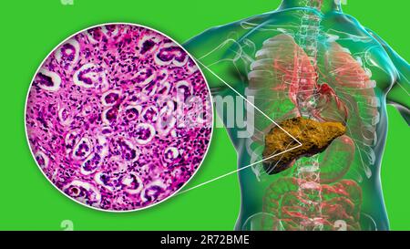 Cirrhose du foie, illustration informatique et micrographe léger d'une section à travers un foie humain souffrant de cirrhose biliaire primitive. La cirrhose est Banque D'Images