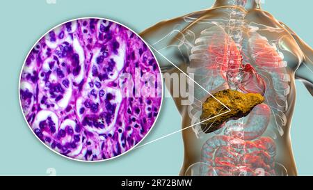 'Cirrhose du foie, illustration informatique et micrographe léger d'une section à travers un foie humain avec Banque D'Images
