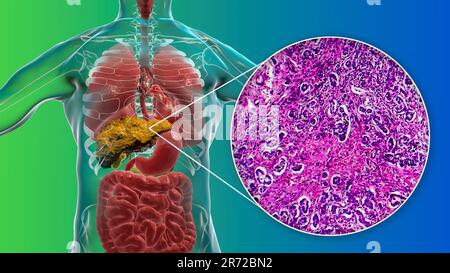 Cirrhose du foie, illustration informatique et micrographe léger d'une section à travers un foie humain souffrant de cirrhose biliaire primitive. La cirrhose est Banque D'Images