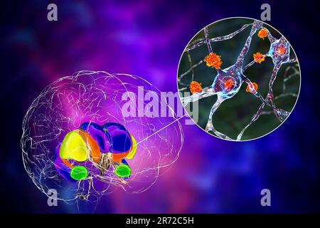 Striatum dorsal et ses neurones dans la maladie de Huntington, illustration informatique montrant les cornes antérieures agrandies des ventricules latéraux, dégénérescence Banque D'Images