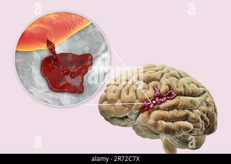 L'AVC hémorragique. Illustration d'une rupture d'un vaisseau sanguin dans le cerveau provoquant une course. Banque D'Images